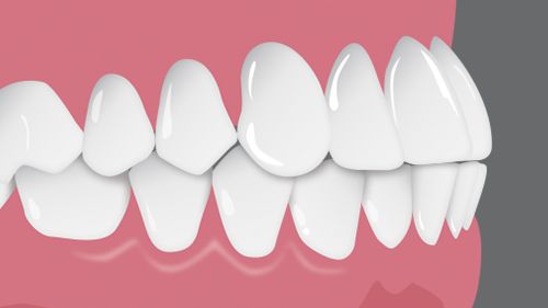 Clear Aligner ช่วยแก้ปัญหาฟันหน้าบนล่างชนกัน