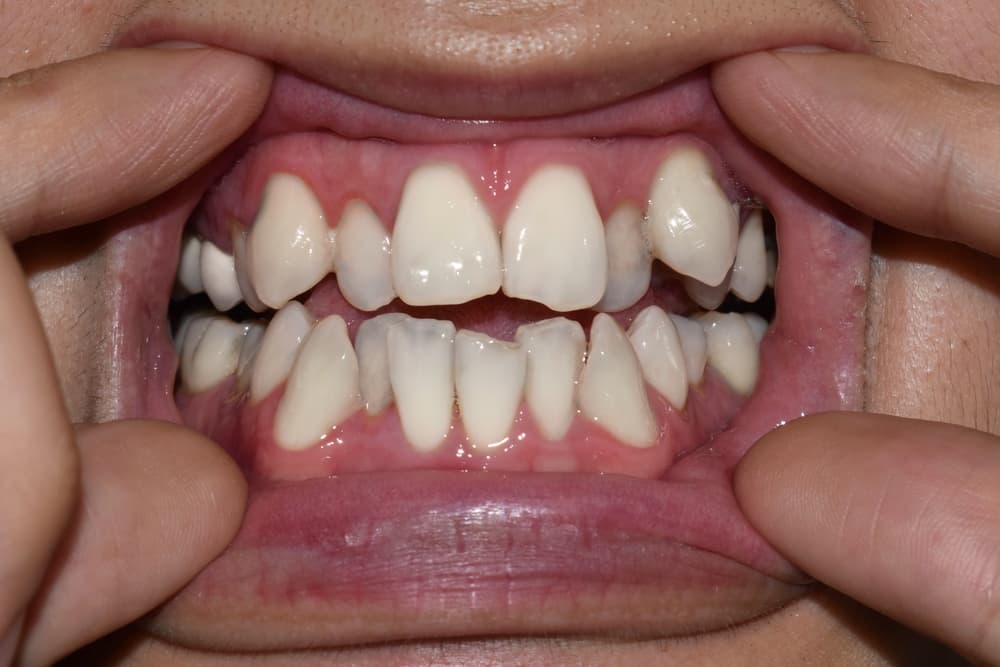 ฟันซ้อน ฟันเก เกิดจากอะไร?